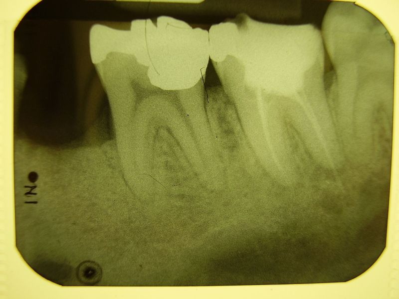 Original source: https://upload.wikimedia.org/wikipedia/commons/thumb/1/13/Dental_X-ray112.JPG/1280px-Dental_X-ray112.JPG